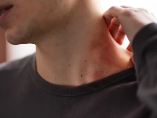 antifungal cream