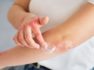 Best Antifungal Cream Suppliers Across India