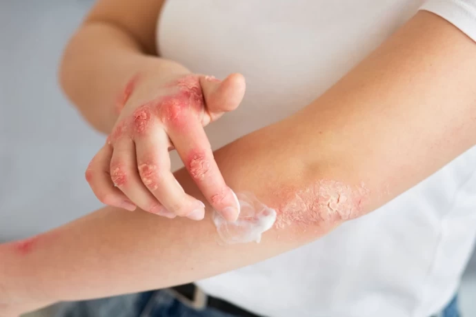 Best Antifungal Cream Suppliers Across India 1