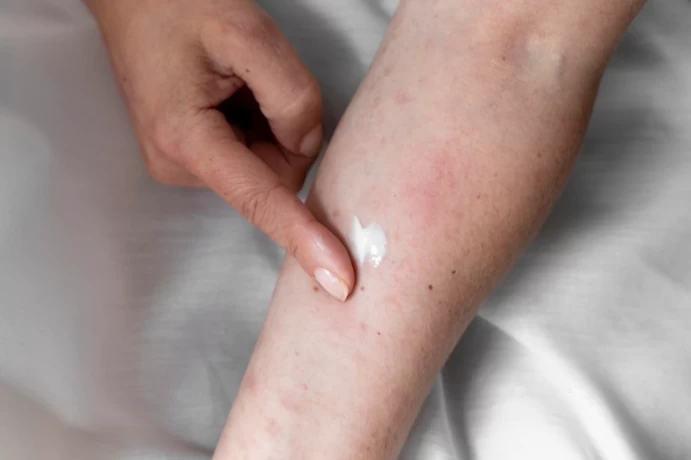 Leading Antifungal Cream Distributors in India 1