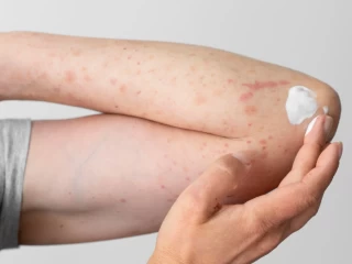 antifungal cream pcd pharma company