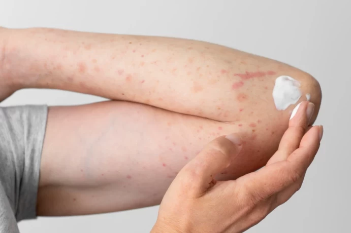 Best Antifungal Cream PCD Pharma Company India 1