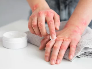 antifungal cream pcd pharma companies