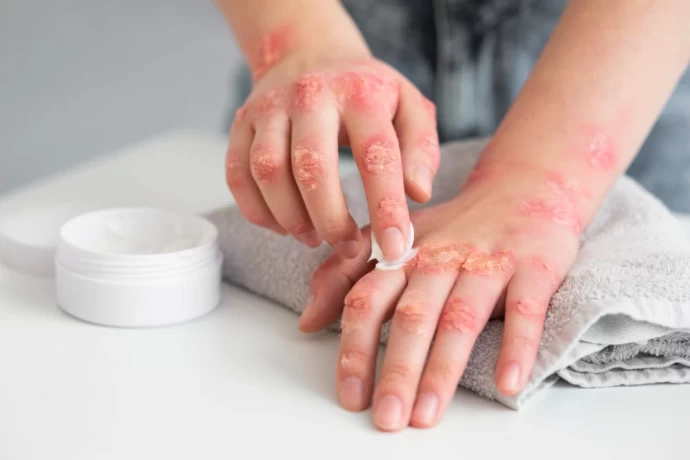 Top Antifungal Cream PCD Pharma Companies in India 1