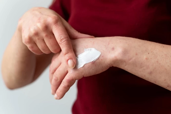 Best Antifungal Cream Franchise Company in India 1