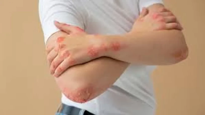 Pharma PCD Franchise for Anti Fungal Cream 1